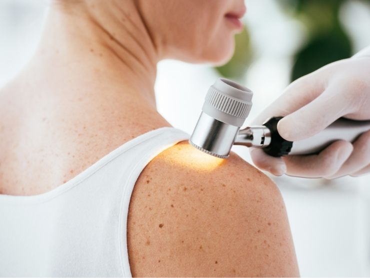 Uno studio sul melanoma